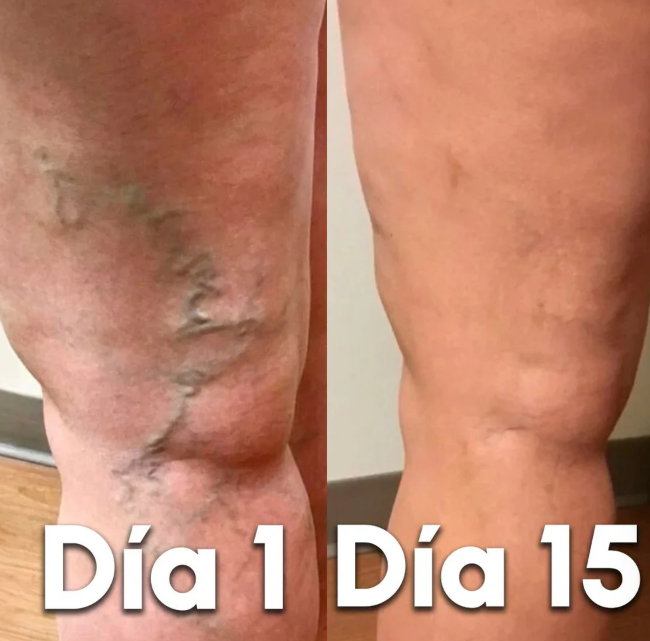 VARICOSE VEINS Spray - Elimina venas varicosas